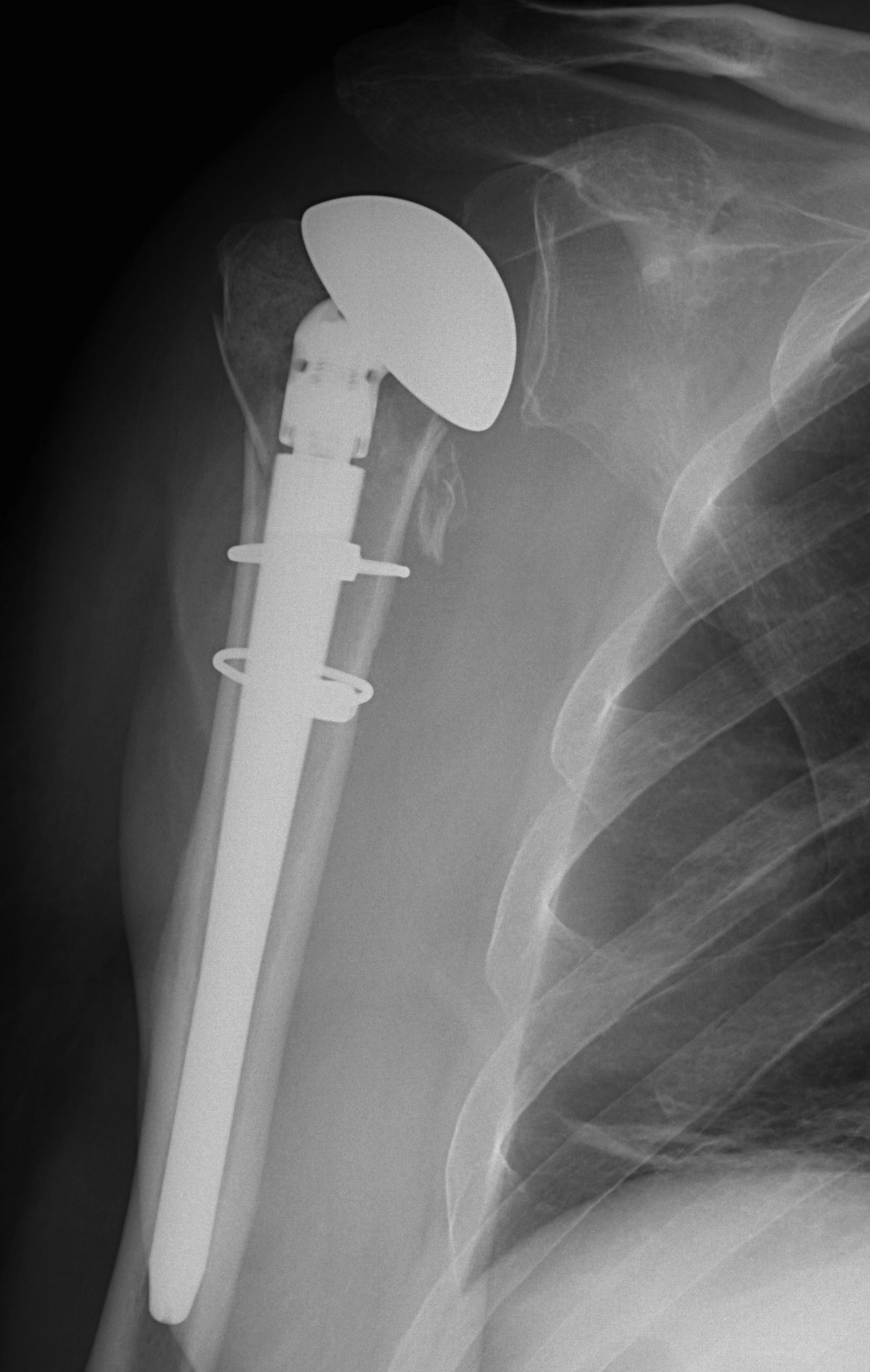 Shoulder Hemiarthoplasty Trauma